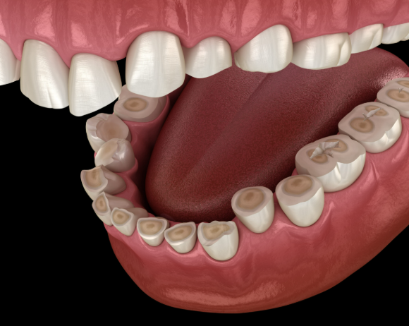 Бруксизм (скрежет зубами во сне): причины, последствия и лечение в Астане